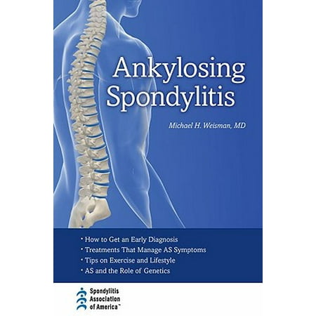 Ankylosing Spondylitis (Best Doctor For Ankylosing Spondylitis)