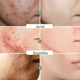 thumbnail image 3 of Sérum Facial Reductor Poros Ácido Salicílico Anti Acné, 3 of 7