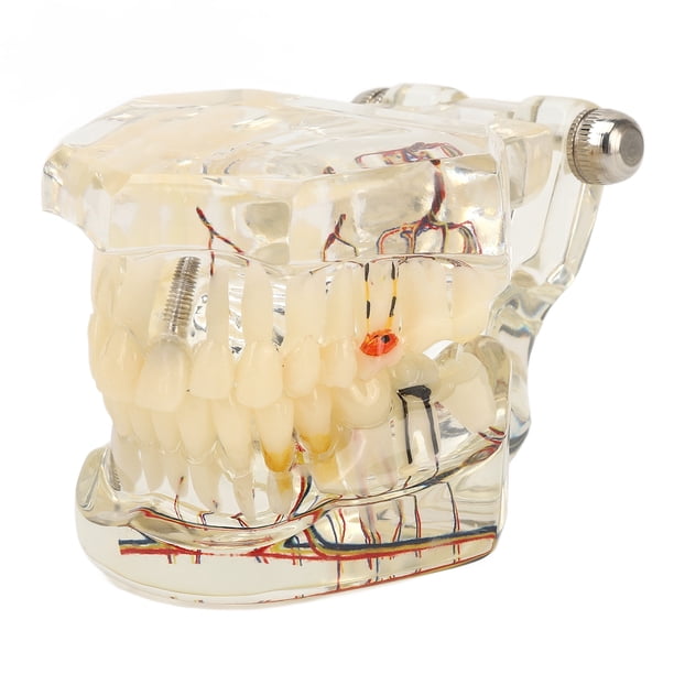 Modelo Patológico De Implante Dental, Implante Dental Transparente Modelo Patológico De Enfermedad De Implante Dental Modelo De Dientes De Enfermedad De Implante Diseño Exquisito