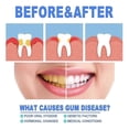 thumbnail image 3 of Gum Shield Gel, Gum Treatment Gel, Gum Disease Treatment Teeth Whitening Essence for Gum Repair, 3 of 5
