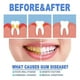 thumbnail image 3 of Gum Shield Gel, Gum Treatment Gel, Gum Disease Treatment Teeth Whitening Essence for Gum Repair, 3 of 4