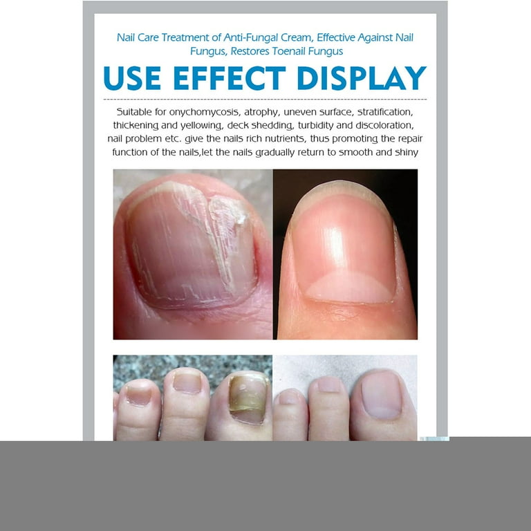 Antifungal Nail Cream v9306.1blu.de