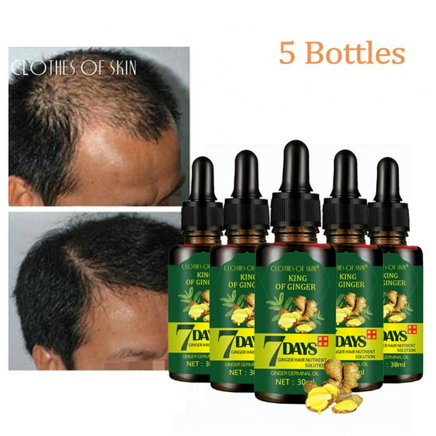 New Upgrade Hair Loss Treatment Ginger Hair Growth Serum For Thicker  Healthier Hair Hair Care For Men And Women 