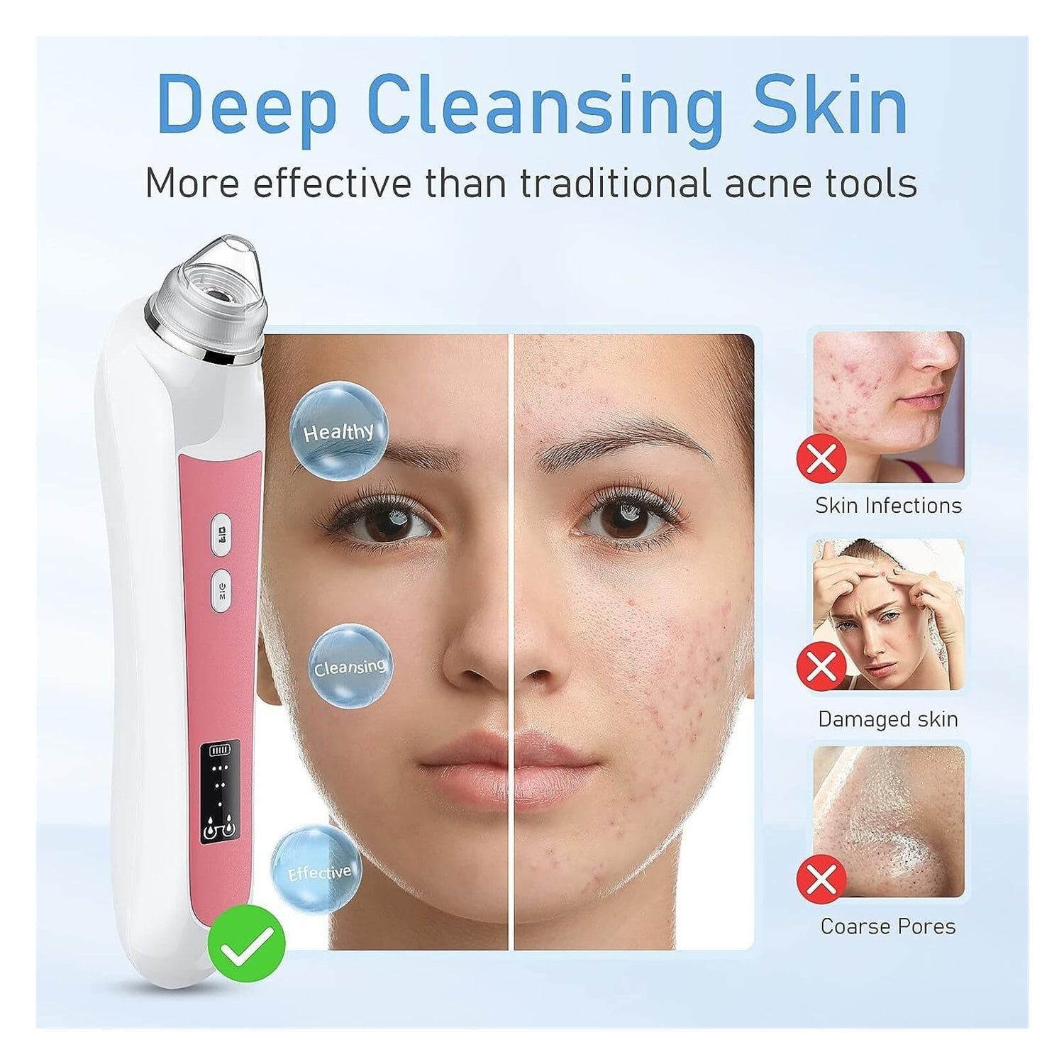 Blackhead Remover Vacuum, USB Interface Type Pore Vacuum, Black Head Extractions Tool with Camerafor, Men and Women Pore Cleaner, 3 Adjustment Modes & 6 Suction Heads(Light Pink)