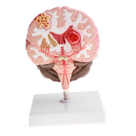 Human Brain Diseased Aneurysm Model Educational Tool