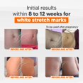 thumbnail image 3 of Cicatrissim Deep Stretch Mark Removal Cream - Innovative Formula With Pure and Powerful Natural Ingredients From Brazilian Flora - For All Stretch Marks & Skin Types., 3 of 7