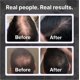 thumbnail image 4 of Shampoo Shapiro MD Hair Growth Experts para pérdida de cabello durante 4 meses, 4 of 6