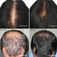 HairMax LaserBand 82 Appareil Médical de Croissance des Cheveux – image 7 sur 8