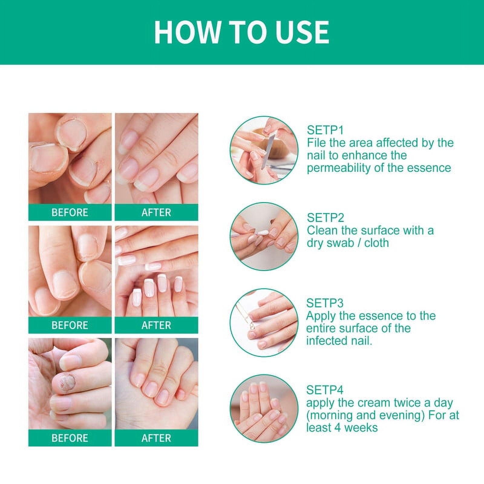 Kerassentials Toenail Treatment Oil, Kerasentials Toenail Nail Treatment for Damaged and Discolored Nails, Nail Treatment Drop For Fungal Infections(3 pcs)