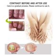 thumbnail image 3 of Gel reparador de uñas, tratamiento de hongos en las uñas de los pies, restaura las uñas amarillas quebradizas para uñas dañadas, 3 of 5