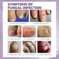 thumbnail image 2 of 2pcs Medinail Fungus Spray New, 2 of 5
