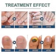 thumbnail image 4 of 96pcs Anti Fungal Nail Treatment-toe-fungus Onychomycosis Repair Sticker -, 4 of 5