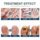 thumbnail image 4 of 96pcs Anti Fungal Nail Treatment-toe-fungus Onychomycosis Repair Sticker -, 4 of 5
