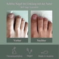 thumbnail image 5 of 2024 -nail Care Pen, Nail Fungus Austrian Experiences, Nail Care Pen Experiences, Nail Fungus Treatment Quick Intensive, Nail Repair Remover - Jjs, 5 of 5