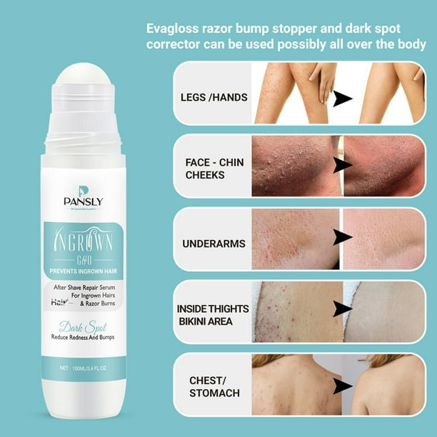 Vellos Encarnados Como Eliminar Pelos Para Siempre Vellos