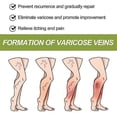 thumbnail image 2 of 1-3pcs Anti-Varicose Cream, Varicose Relief Cream, Anti-Varicose Soothing Cream, Varicose Relief Cream For Legs, 2 of 5