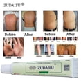 thumbnail image 3 of 5pcs Zudaifu Skin Psoriasis Cream, 3 of 3