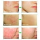 thumbnail image 1 of Crema Antiacné Crema Para Reducir Los Poros Crema Para El Cuidado De La Piel De La Cara 20g Crema Antiacné Eliminación De Cicatrices De Acné Gel Blanqueador Hidratante Crema ANGGREK Descripción de la referencia, 1 of 5