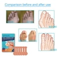 thumbnail image 1 of 2pcs Toe Corrector Composite Patch, Relieve Big Toe Valgus Joint Pain And Swelling Foot Care Correction Patch, 1 of 5