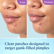 Differin Power Patches for White Head Pimples, Hydrocolloid Acne Patches, Zinc Hyaluronate and Niacinamide, 23 ct