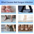 thumbnail image 5 of Nail Fungal Patches for Fungus Finger Toe Nail Repair Plaster Stickers, 5 of 5