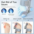 thumbnail image 4 of Bunion Corrector for Women & Men with Adjustable Knob Silicone Pad, Bunion Relief Big Toe Splint for Left/Right Feet, Gray, 4 of 10