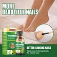 Nail Fungus Treatment Restores The Healthy Appearance Of Nails nail-fungus-treatment-restores-the-healthy-appearance-of-nails
