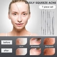 thumbnail image 5 of Blackhead Remover Tool Kit - 7 Pcs Pimple Popper Comedone Extractor Acne Removal Tool for Blemish Whitehead Popping, Zit Removing for Nose Face, Stainless Steel Pimple Tools with Metal Case, 5 of 7
