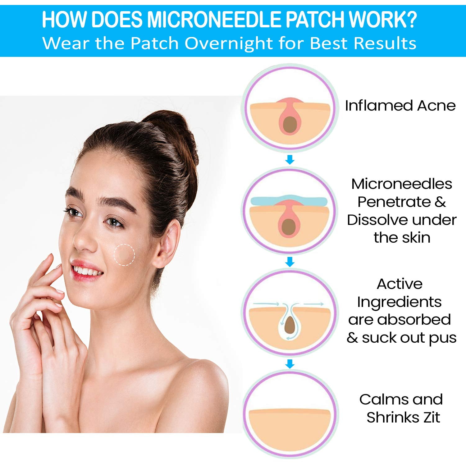 Microneedle shop acne patch