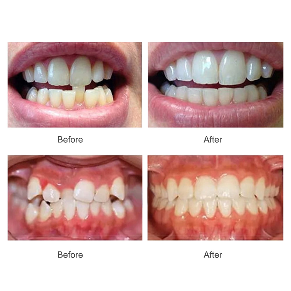 Dental Braces Kit,Orthodontic Teeth Trainer,Tooth Retainers,3 Stage Teeth Straightener for Adults