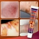 thumbnail image 2 of Crema antibacteriana para quemaduras, ungüento antiinfección para aliviar el dolor de heridas, suministros profesionales para el cuidado de la piel, 2 of 4