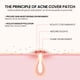 thumbnail image 5 of Price Drop Acne Patch For Skin Cleaning, Acne Warts, Skin Labels, Wart Cleaning, Closing Mouth, Gentle Fading, Acne Balance, Skin Acne Patches, 5 of 9