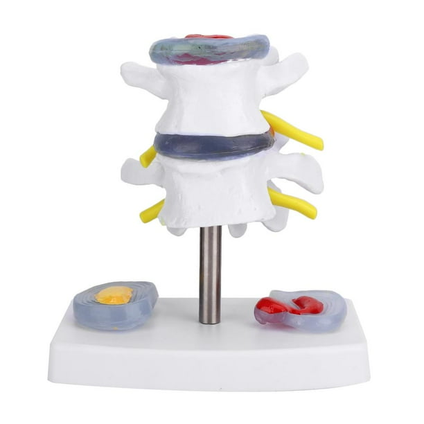 Modelo de hernia de disco lumbar EOTVIA Anatómico Humano Suministros de Entrenamiento para la Escuela de la Columna Vertebral Humana