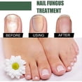 thumbnail image 5 of Nail Fungus Treatment, 50ml Toenail Fungus Treatment, Extra Strong Nail Repair Solution with Natural Tea Tree Oil Extract, 5 of 5
