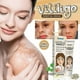 thumbnail image 3 of Extract Vitiligo Ointment Remove Ringworm White Spot Removal Skin Vitiligo Eliminate Vitiligo Treatment Cream_c*, 3 of 5