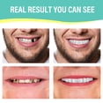 thumbnail image 4 of Fake Teeth, Denture Teeth, Confidence Smile Temporary Teeth, 4 of 5