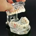 thumbnail image 2 of Dental Models Repairable Resin Models Of Diseased Teeth For Teaching And Research In Medicine And Dental Diseases, 2 of 4
