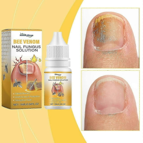 Bee Venom Fungal Nail Treatment for Toenail Extra Strong, Nail Fungus Solution, Anti Toe Toenail Nail Fungal Solution for Ingrown Toenail Treatment