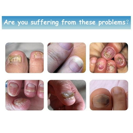 Anti Fungal Nail Treatment Finger Toe Care Nail Fungus ...