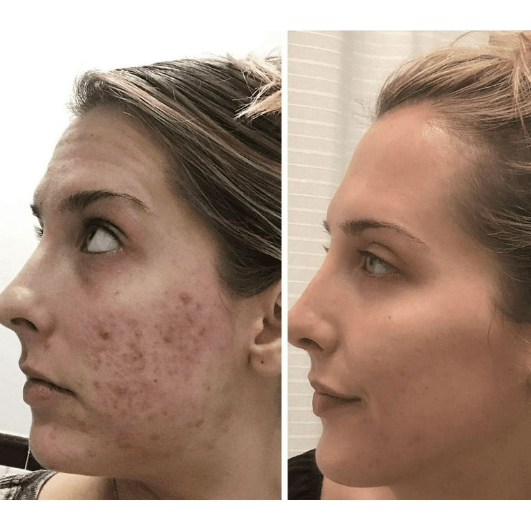 hyaluronic-acid-cream-before-after