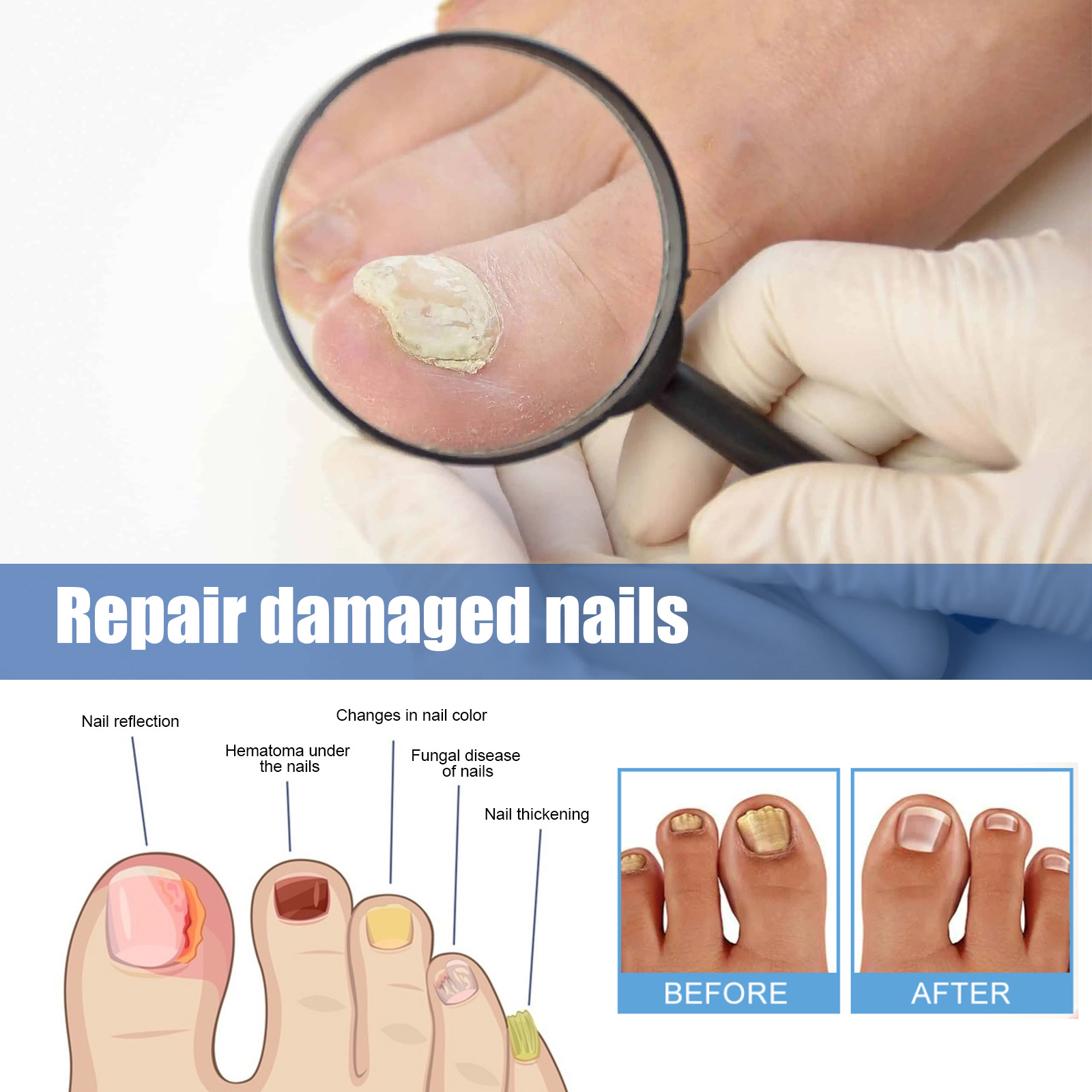 Alvantor Fungal Nail Patches, Overnight Repair for Damaged Thick Toenails, 8-Hour Treatment, 32PCS