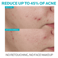 thumbnail image 5 of La Roche-Posay Effaclar Salicylic Acid Acne Serum, Pore Minimizing Acne Treatment with Niacinamide, 1.0 fl oz, 5 of 9