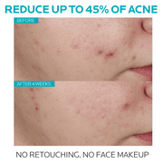 La Roche-Posay Effaclar Salicylic Acid Acne Serum, Pore Minimizing Acne Treatment with Niacinamide, 1.0 fl oz