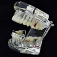 thumbnail image 4 of Vampire Fangs Half Grillz Silver Tone Slim Bottom Lower Fang Canine Teeth Grills, 4 of 6