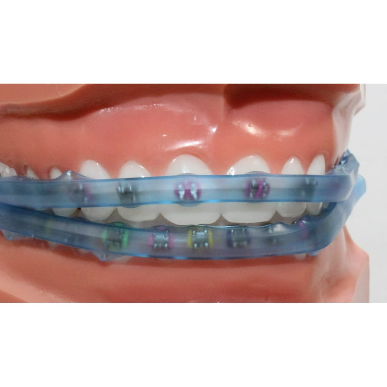 Comfort Cover Braces Guard/Lip CI30 and Mouth Protector - Snap on Cover  Strip for Braces - Orthodontic/Dental Quality (Blue) 
