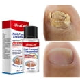 thumbnail image 1 of Esencia de eliminación de hongos en las uñas Gel líquido para uñas de manos y pies Gel de paroniquia para onicomicosis, 1 of 9