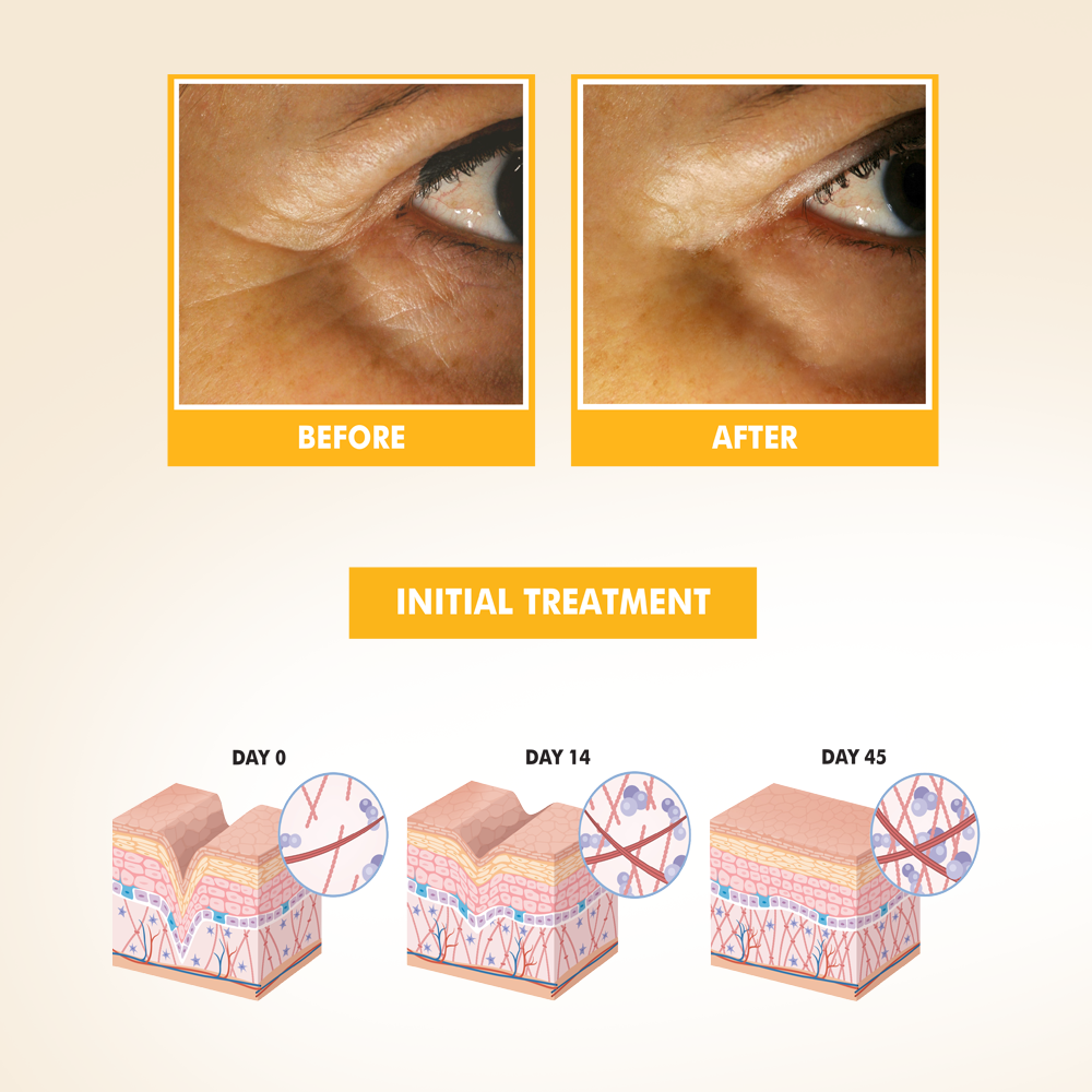 NIKA SKIN CARE - Anti Aging Intensive Treatment - Botox Alternative - Moisturizer with Collagen, Matrixyl & Argireline Peptides, Hyaluronic Acid, Collagen, Retinol, and Apple Stem Cells
