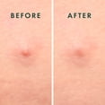 thumbnail image 4 of Rael Miracle Microcrystal Spot Cover - Hydrocolloid, Patches with Tea Tree Oil, Early Stage (36 Count), 4 of 9