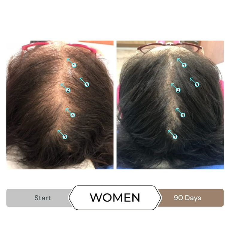 Revita Shampoo w/Biotin, and Hair Growth Stimulating Ingredients, Helps Block DHT w/DNC-N Nanoxidil 5% Hair Regrowth Treatment - Walmart.com