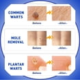 thumbnail image 3 of Líquido de ácido salicílico para eliminar verrugas y lunares, 30 ml, Gaayou, 3 of 7